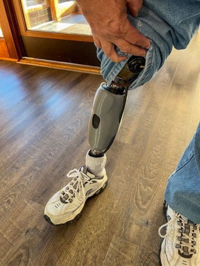 above-knee prosthesis