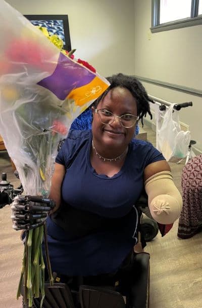 bionic arm prosthesis