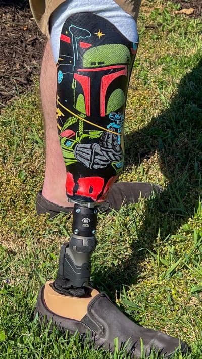 custom designed prosthesis